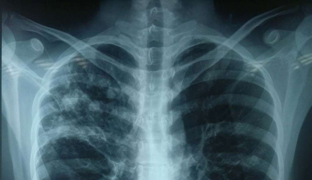 pulmonary parenchymal bands