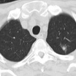 What is a ground glass lung nodule?