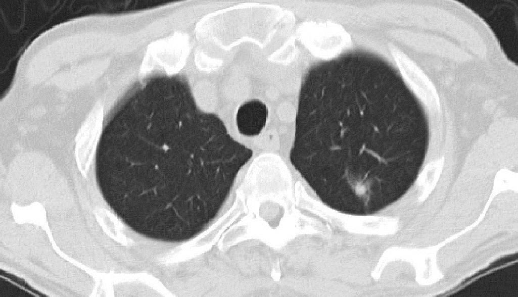 ground glass nodule