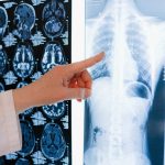 Cancer risk estimation of lung nodules